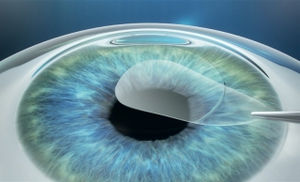 Smile surgery recovery